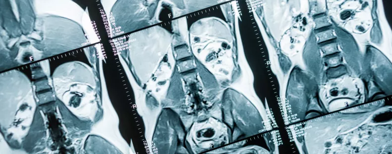 Egy hatalmas daganatot akarnak eltávolítani a nő hasából: amit találnak, az orvosokat is sokkolja – Fotók