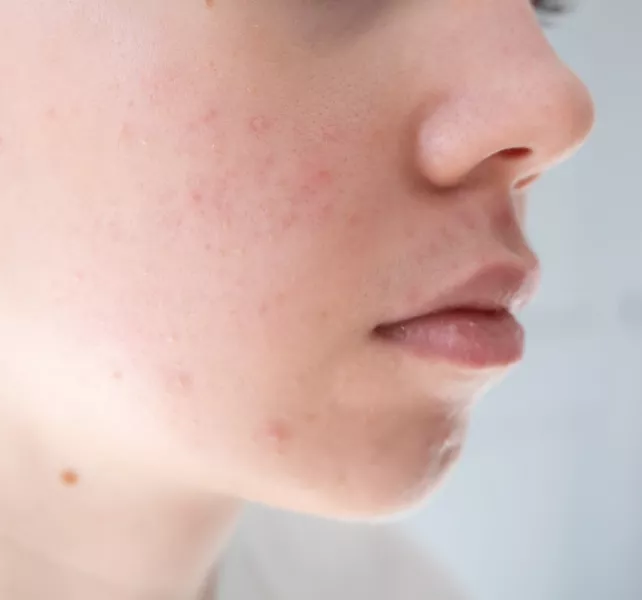 árulkodó, jelek, bőr, alkohol, cukor, 