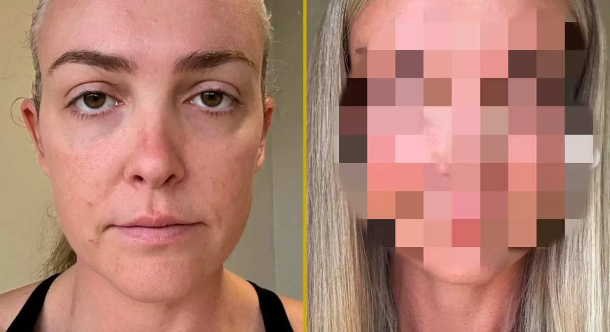 „Valaki FIZETETT ezért?”: Szétszedik a nőt a plasztika előtti és utáni képe miatt