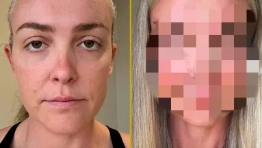 „Valaki FIZETETT ezért?”: Szétszedik a nőt a plasztika előtti és utáni képe miatt