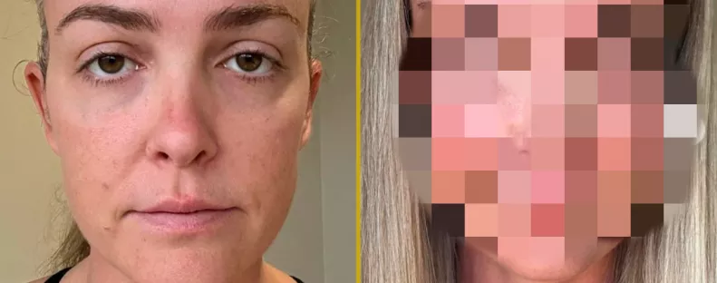 „Valaki FIZETETT ezért?”: Szétszedik a nőt a plasztika előtti és utáni képe miatt