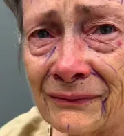 Csodaként terjed a plasztikai beavatkozás: évtizedekkel lett fiatalabb a nagyi