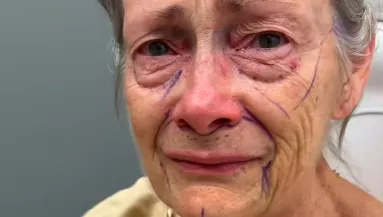 Csodaként terjed a plasztikai beavatkozás: évtizedekkel lett fiatalabb a nagyi