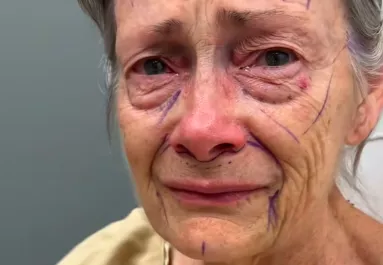 Csodaként terjed a plasztikai beavatkozás: évtizedekkel lett fiatalabb a nagyi