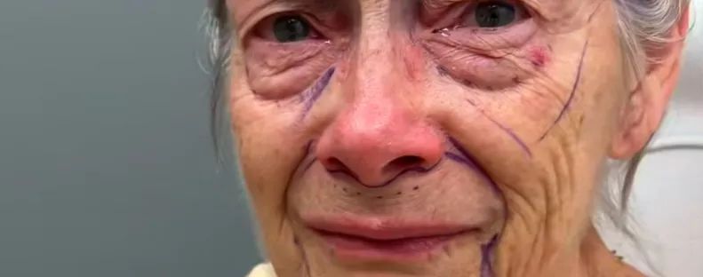 Csodaként terjed a plasztikai beavatkozás: évtizedekkel lett fiatalabb a nagyi