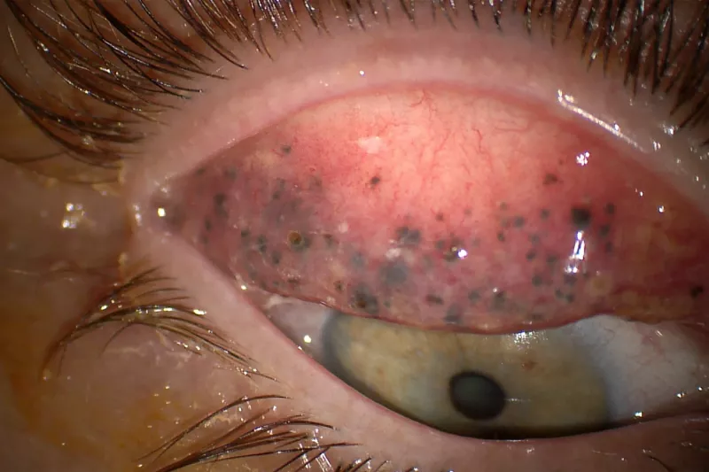 smink, theresa lynch, orvos, baki, 